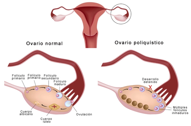 Enclomiphene and Polycystic Ovary Syndrome (PCOS): A Potential Treatment?