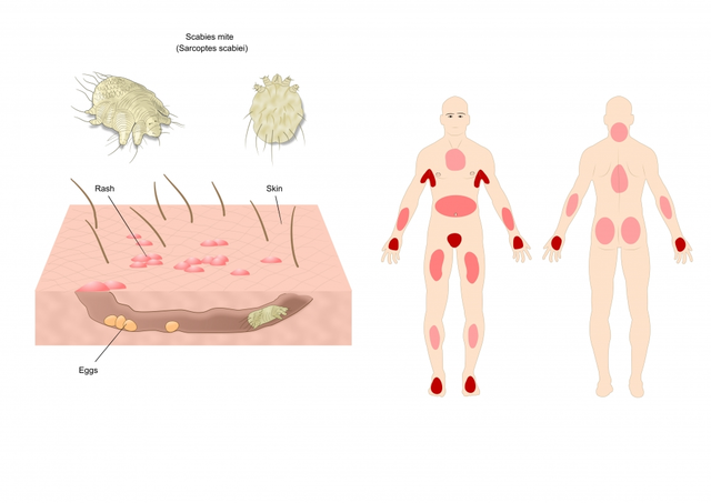 The connection between Sarcoptes scabiei and other skin conditions